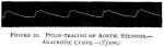 Figure 20. Pulse-tracing of Aortic Stenosis.